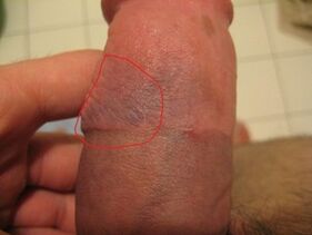 hematom na penisu zaradi nepravilne uporabe črpalke